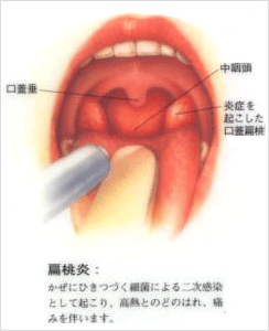 扁桃 腺 白い