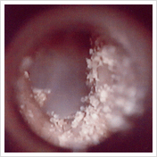 加賀耳鼻咽喉科クリニック 耳かき評論 耳垢タイプについて