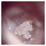 加賀耳鼻咽喉科クリニック 耳かき評論 耳垢タイプについて