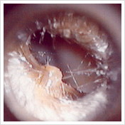 加賀耳鼻咽喉科クリニック 耳かき評論 耳垢タイプについて